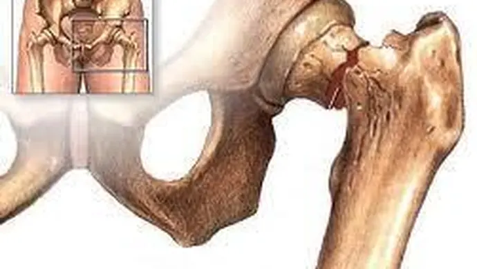 Badania na osteoporozę przy Starostwie we Wschowie