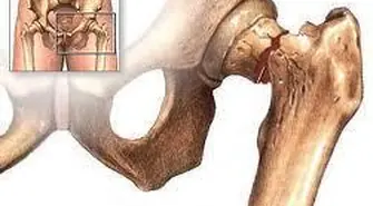 Badania na osteoporozę przy Starostwie we Wschowie
