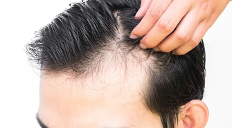 Dlaczego warto zdecydować się na przeszczep włosów? Turcja to dobry pomysł? 