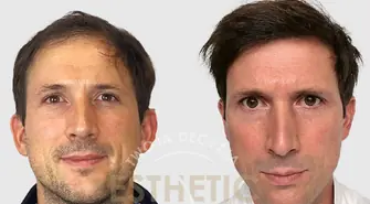 Esthetic Trip - przeszczep włosów